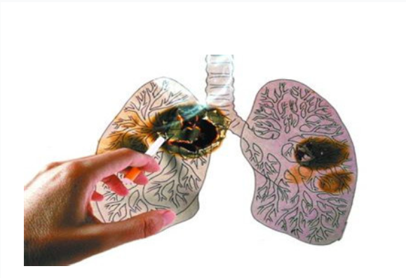 Lung Cancer Statistics